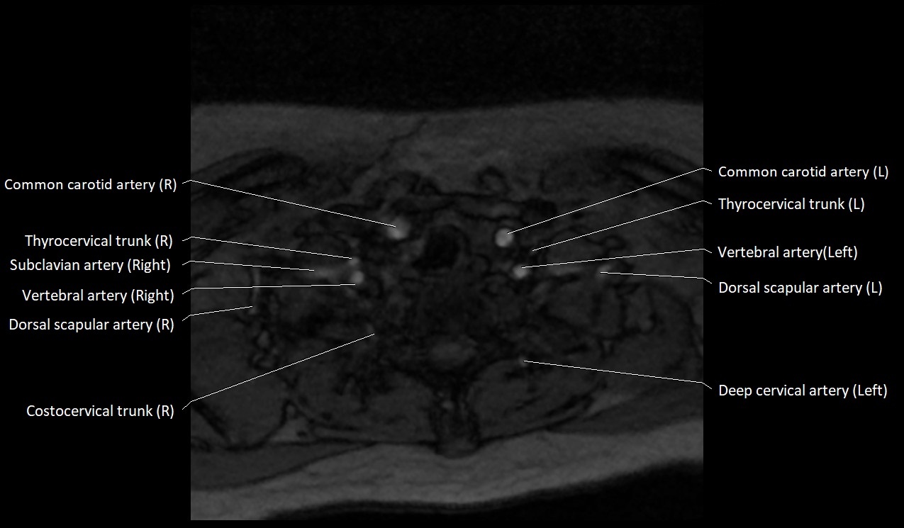 Carotid artery anatomy axial 3T image 66.jpg